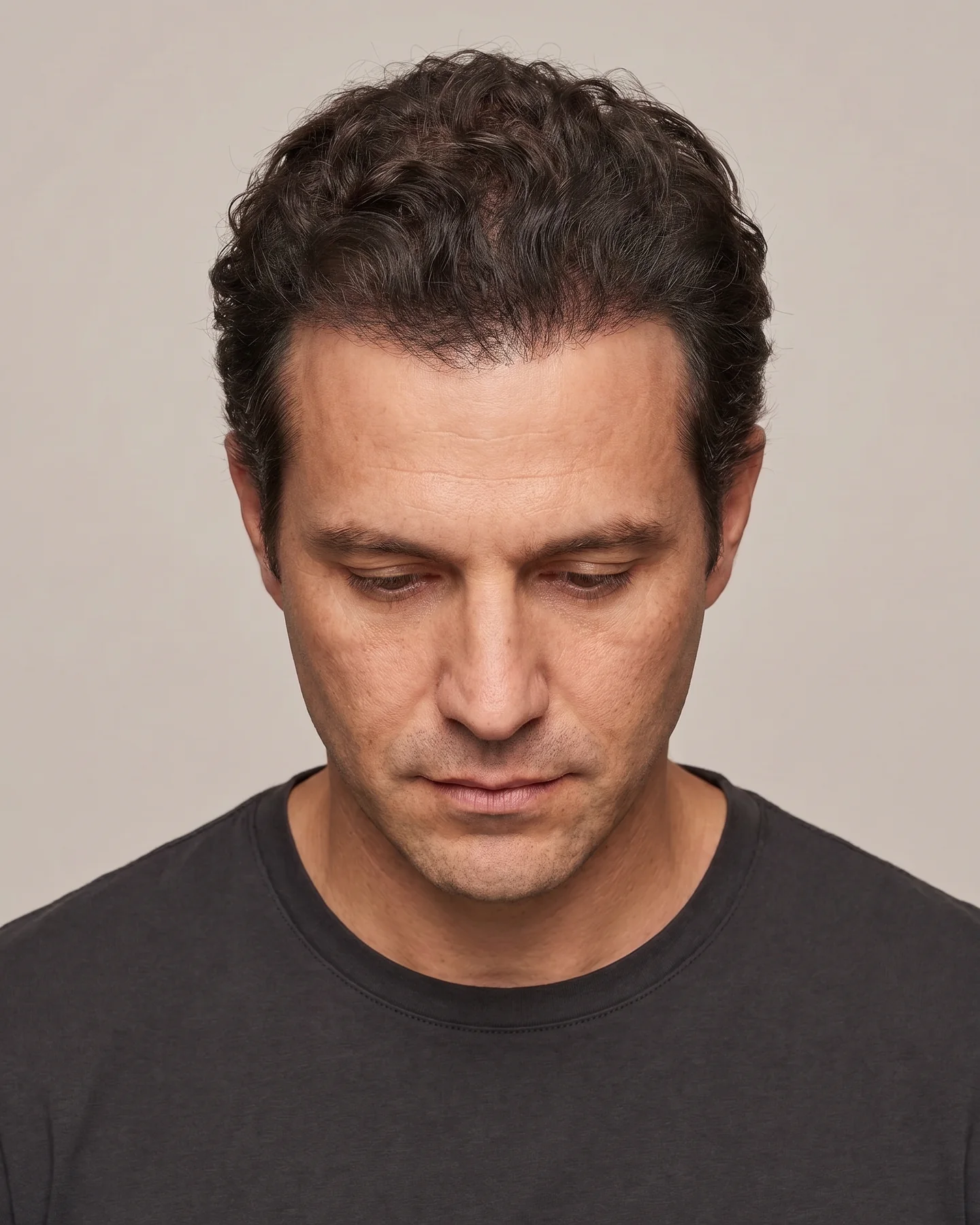 Caso 03, densidade frontal e midscalp após o procedimento.